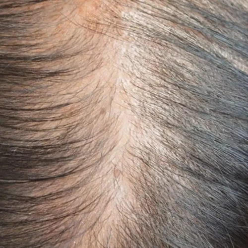 Unexpected Hair Loss Reported After Single-Dose Intravesical Gemcitabine in Bladder Cancer Patients: Case Series