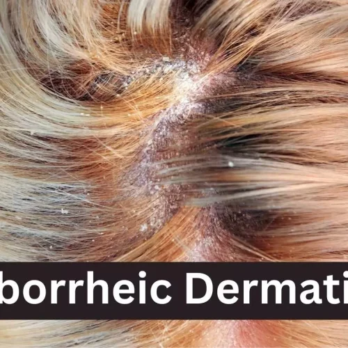 Study Reveals Two-Way Link Between Seborrheic Dermatitis and Other Barrier Diseases