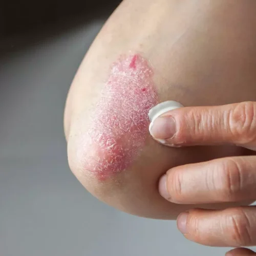 Patients with coexisting psoriasis and diabetes face elevated all-cause mortality risk: Study