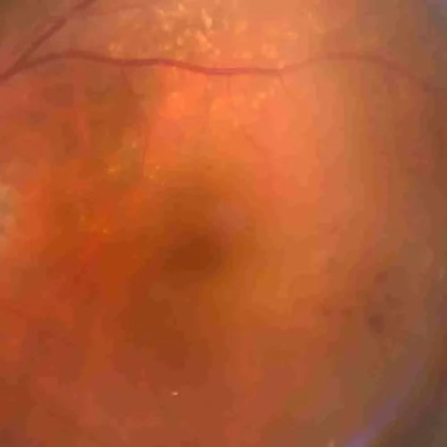 Red Cell Distribution Width-to-Albumin Ratio Shows Nonlinear Link With Retinopathy Risk: Study