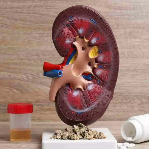 Largest study of its kind tests hydration strategy for kidney stones
