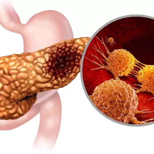AI Detects Pancreatic Cancer More Accurately Than Radiologists, Finds Research