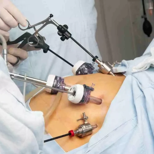 One anastomosis gastric bypass linked to Lower Marginal Ulcer Risk Compared to RYGB: Study