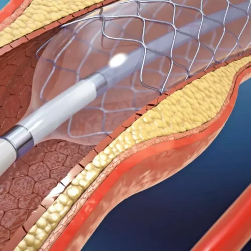 Hemodialysis Patients Face Higher Restenosis Risk After DCB Therapy, But Limb Salvage Remains High: POPCORN Registry
