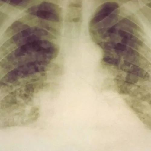 Rheumatoid Arthritis-Linked Lung Disease Significantly Raises Risk of Death, Finds Study