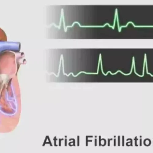Heading:

Heart Failure Patients with Atrial Fibrillation Undergoing Transcatheter Mitral Repair at increased Risk of Death or Rehospitalization: Study