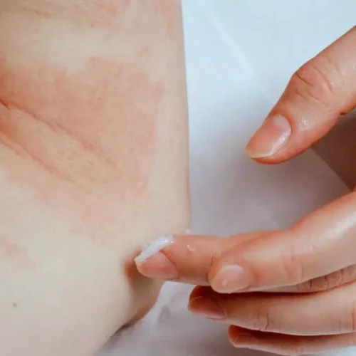 Baricitinib + TCS Outperforms Azathioprine in Moderate-to-Severe Atopic Dermatitis: Study