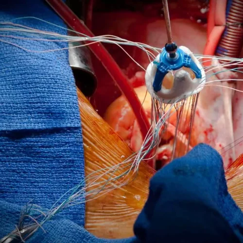 New Study identifies early signs of valve failure one year after TAVI, raising durability concerns in younger patients