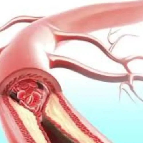 Intensive LDL-C Targeting Enhances Clinical Outcomes in CVD: NEJM