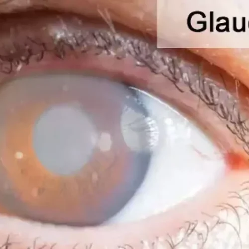 Dietary Nitrate Intake from Leafy Green Vegetables Tied to Reduced Glaucoma Risk: Study