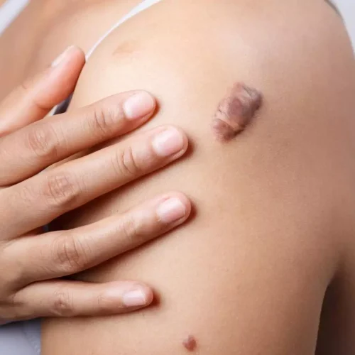 Postoperative Radiotherapy Significantly Reduces Keloid Recurrence Compared to Surgery Alone: Study