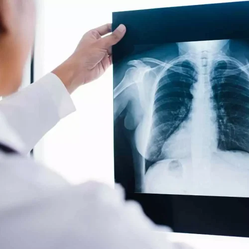 AI based chest CT images accurate in predicting lung function of COPD patients: Study