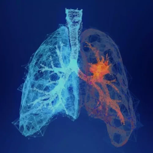 Talc or Minocycline Pleurodesis May Aid managing malignant pleural effusion Management in Lung Cancer with ILD: Study