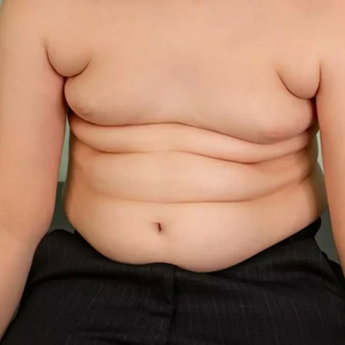 BMI Reduction Improves Cardiometabolic Risk in both metabolically healthy and unhealthy Obese Children: JAMA