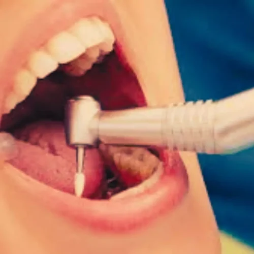 MA-T Shows Potential as Safer, Effective Root Canal Irrigant compared to sodium hypochlorite: Study