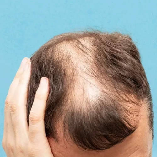 Ritlecitinib effective against moderate to severe alopecia areata over long term: Study
