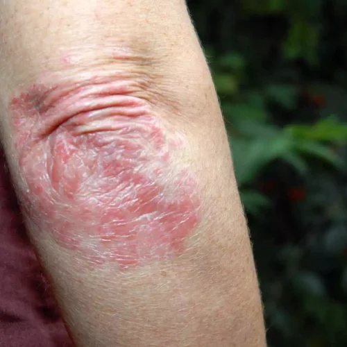 Roflumilast Cream 0.3% Safe and Effective for Plaque Psoriasis in Children Aged 2–11 Years: Study