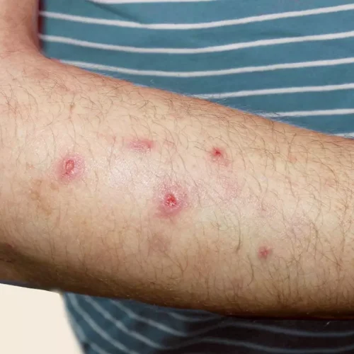 Prurigo Nodularis Greatly Increases Risk of Atopic Diseases, Especially Atopic Dermatitis, suggests study