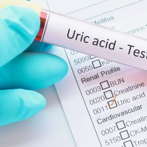 Higher long-term variability of serum uric acid associated with diabetic retinopathy risk: Study