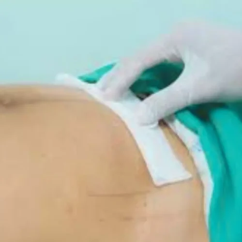 Synthetic Mesh Remains Standard for Inguinal Hernia Repair, suggests JAMA study