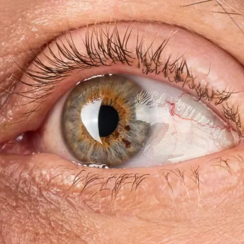 Smart eye patch uses fluorescence to monitor eye health, finds research