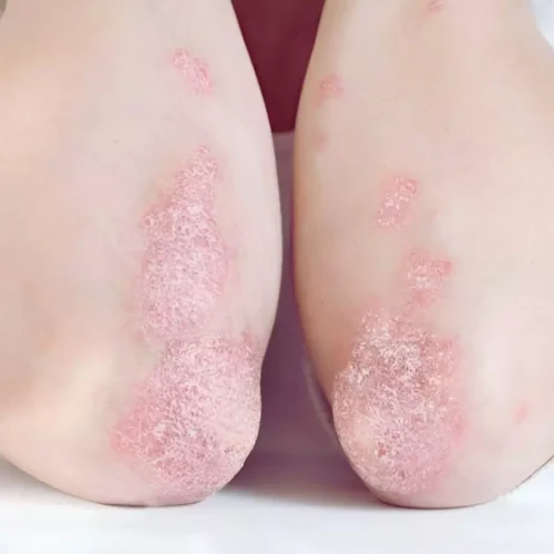 Secukinumab Offers Better Psychological Benefits in Psoriasis Treatment: Study