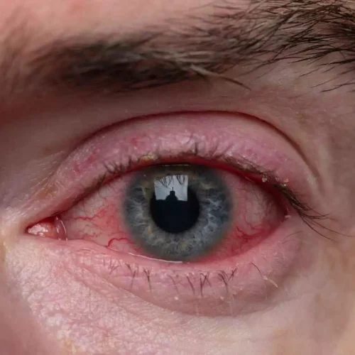 FDA Approves Prednisolone Acetate Ophthalmic Suspension for Ocular Inflammation