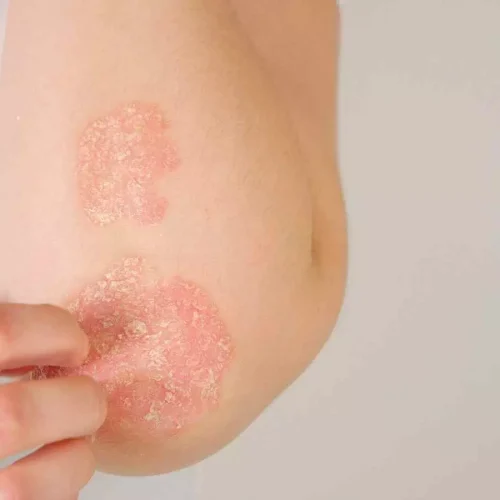 Guselkumab Effective and Long-Lasting Psoriasis Treatment Across All Skin Tones, suggests study