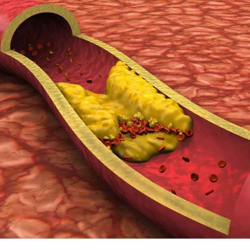 Pregnant women with preexisting high cholesterol may have elevated CV risk,  reveals study