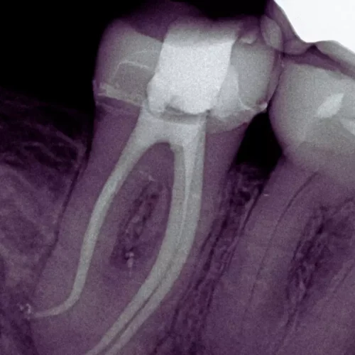 Non-Surgical Root Canal Resolves Rare Mandibular Molar Malformation in Teenager: Case Report