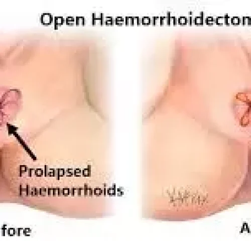 Metronidazole effectively reduces  pain in patients after hemorrhoidectomy: Study