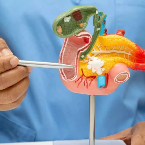 ERCP With Minor Papillotomy Fails to Prevent Recurrent Pancreatitis: JAMA