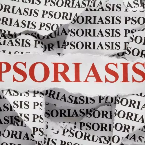 New gene discovery paves way for tailored psoriasis treatments,  reveals research