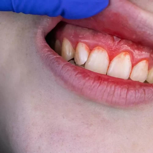 Gum Disease Linked to Increased Risk of Gestational Diabetes: Study