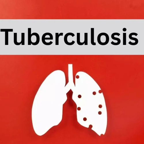 Low BMI Raises Risk of TB in IGRA-Positive Contacts,  suggests research