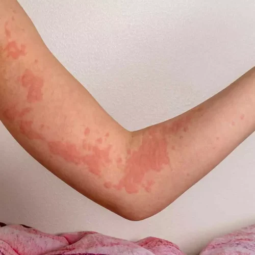 Dupilumab Improves Itch and Disease Activity in Chronic Spontaneous Urticaria Regardless of BMI, Gender: Study