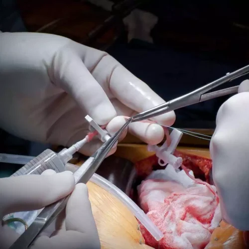 De-escalation of DAPT provides benefits in patients after CABG: ESC Study