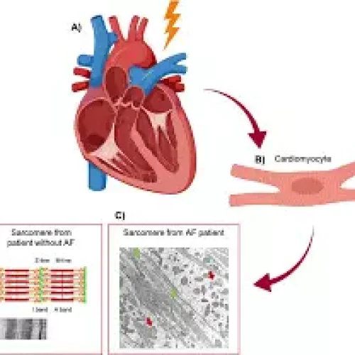 Genetic Link Found Between Early-Onset AF and Risk of Cardiomyopathy or Heart Failure: Study
