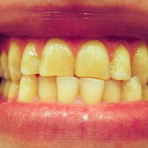 Sleep Bruxism Linked to Higher TMD Recurrence Post-Treatment: Study