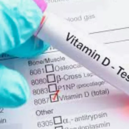 Vitamin D Deficiency associated with Diabetic Nephropathy in Type 2 Diabetes: Study