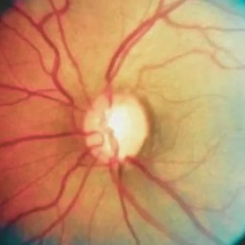 Obstructive Sleep Apnea Doubles Risk of Severe Glaucoma Progression, Study Finds