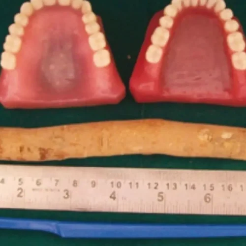 Toothbrush-shaped ultrasound allows for gum monitoring, reports research
