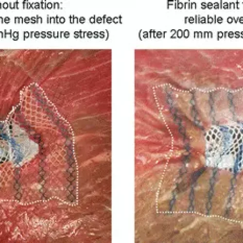 Positive-Pressure Exhaust Technique Improves Mesh Fixation in TAPP Hernia Repair: Study