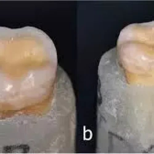 Immediate Dentin Sealing may  Improve Adhesion and Restoration Durability in both healthy and eroded dentin: Study