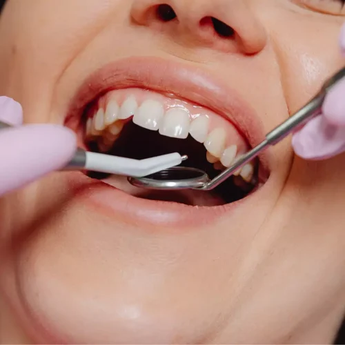 Combination of exercise and omega-3 reduces the severity of tooth root infections, suggests study