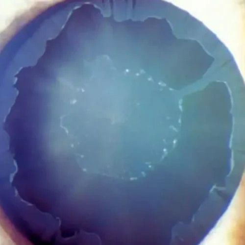Pseudoexfoliation Syndrome May Predict Glaucoma via Ganglion Cell Layer Thinning: Study