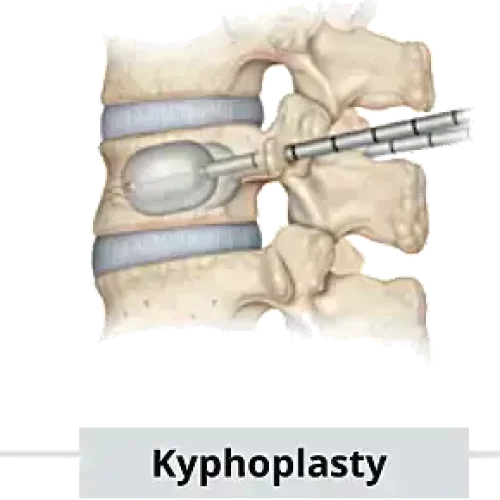Optimizing Anesthetic Techniques for Percutaneous Kyphoplasty: A Comparative Study of TPVB and Local Infiltration