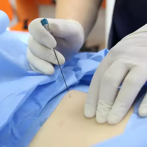 Intercostal Nerve Block Matches Epidural for Pain Relief in minimally invasive Lung Surgery: JAMA