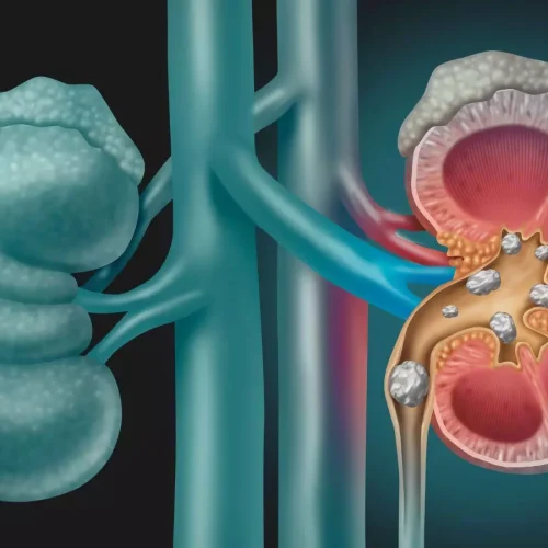 Dietary changes and medications could help prevent recurrent kidney stones,  finds study