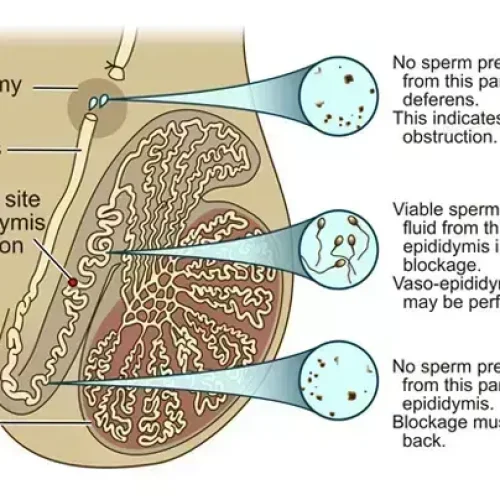 Intra-operative measurements of testicular vasal lumen diameter can be an adjunctive factor that may influence choice of VR technique: Study